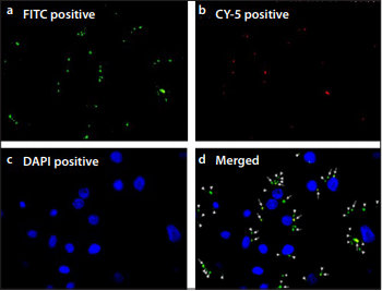 Effect of Staphylococcus Aureus on the NLRP3 Inflammasome, Caspase-1 and IL-1 β Expression in the Nasal Epithelial Cells in Chronic Rhinosinusitis