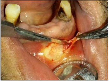 Inadvertent Injection of Sodium Hypochlorite to Oral Mucosa