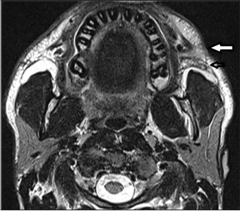 Sequential Pictorial Evidence of Excision of Ectopic Accessory Parotid Fistula in an Adult - A Rare Clinical Entity