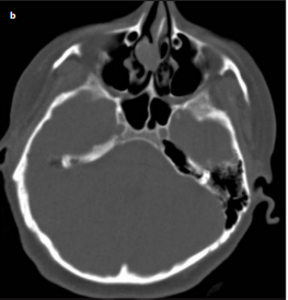 Dermoid Cyst Arising from the Middle Turbinate: A Case Report